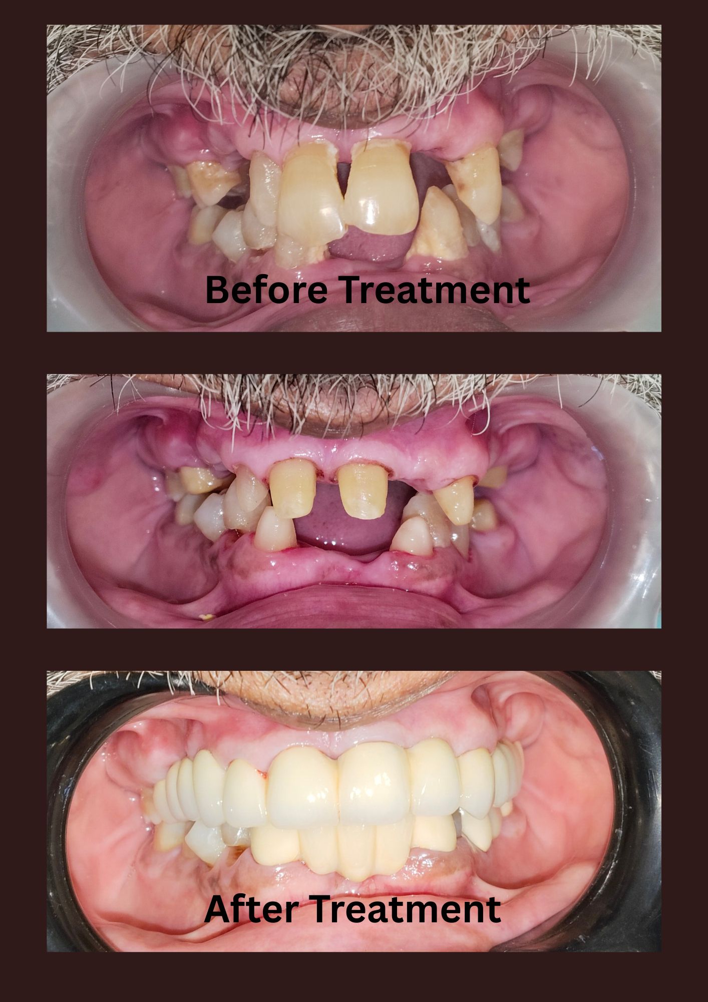 Full Mouth Rehabilitation